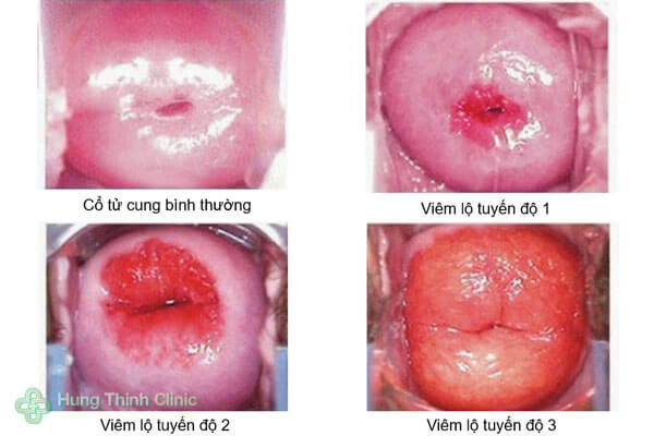 Hình ảnh viêm lộ tuyến cổ tử cung độ 1, 2, 3, 4 hình ảnh siêu âm