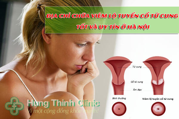 Địa chỉ chữa viêm lộ tuyến cổ tử cung tốt và uy tín ở Hà Nội