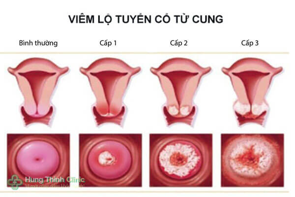 Hình ảnh viêm lộ tuyến cổ tử cung độ 1, 2, 3, 4 hình ảnh siêu âm