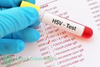 Virus HSV là gì? Xét nghiệm HSV ở đâu tốt tại Hà Nội [TOP 5 Địa chỉ]