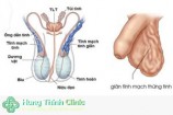 Bệnh giãn tĩnh mạch tinh hoàn nên khám ở đâu Top 8 địa chỉ uy tín