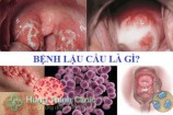 Bệnh lậu là gì? nguyên nhân triệu chứng cách điều trị hiệu quả