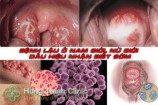 Bệnh lậu ở nam giới, nữ giới: Top 10+ dấu hiệu nhận biết sớm thường gặp nhất
