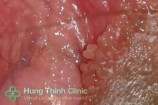 Bệnh sùi mào gà ở nữ, nam giới 10 dấu hiệu thường gặp sớm nhất