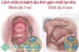 Top 19 cách chữa bệnh lậu đơn giản nhất tại nhà