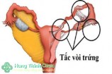 10 Cách chữa trị tắc vòi trứng an toàn hiệu quả