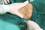 Cắt tuyến mồ hôi nách bao nhiêu tiền ở đâu tốt?