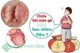 Chi phí chữa sùi mào gà hết bao nhiêu tiền? [Giá chỉ từ 2 triệu]