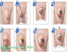 Dài bao quy đầu có ảnh hưởng gì không? Cách chữa trị