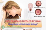 Điều trị viêm lộ tuyến cổ tử cung bằng thuốc có khỏi được không?