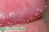 Gai sinh dục nam có nguy hiểm không? giải đáp của chuyên gia