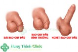 Hình ảnh bao quy đầu bình thường ở người lớn