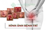 Hình ảnh bệnh trĩ nội, trĩ ngoại qua các giai đoạn của bệnh
