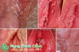 Hình ảnh sùi mào gà ở vùng kín nữ, nam giới ở Hậu Môn