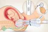 Hút thai lần đầu có ảnh hưởng gì không? sau bao lâu có kinh trở lại?