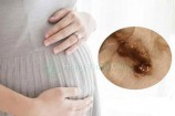 Mang thai tháng đầu ra dịch màu nâu, ra máu có sao không?