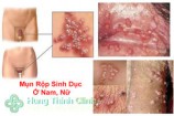 Mụn rộp sinh dục là gì 10 dấu hiệu nhận biết sớm nhất