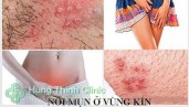 Nổi mụn ở vùng kín ở nữ, nam giới là dấu hiệu của bệnh gì?