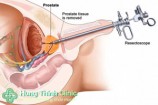 Phì đại tuyến tiền liệt là gì? có nguy hiểm không cách chữa