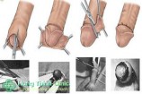 Tư vấn phương pháp phẫu thuật cắt bao quy đầu an toàn