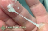Khí hư màu xanh như nước mũi nguyên nhân cách chữa hiệu quả