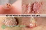 Sùi mào gà nguyên nhân triệu chứng cách điều trị hiệu quả