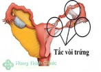 [TOP 7 địa chỉ] Chữa tắc vòi trứng ở đâu tốt? Cách điều trị hiệu quả