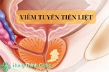 Tuyến tiền liệt là gì? dấu hiệu triệu chứng nguyên nhân và cách chữa