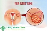 Viêm buồng trứng TOP 12 dấu hiệu dễ nhận biết sớm nhất