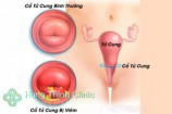 Viêm cổ tử cung là gì? dấu hiệu triệu chứng cách chữa bệnh