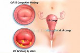 Viêm cổ tử cung nhẹ và mãn tính phân biệt, cách điều trị