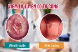 Viêm lộ tuyến cổ tử cung có nguy hiểm không bị có được quan hệ không?