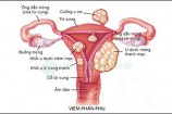 Viêm phần phụ là gì? Nguyên nhân triệu chứng cách điều trị