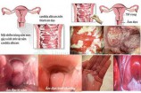 Vùng kín có mảng bám màu trắng nguyên nhân cách chữa hiệu quả