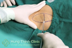 Cắt tuyến mồ hôi nách bao nhiêu tiền ở đâu tốt?