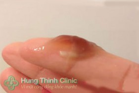 Máu báo thai có dịch nhầy không? phân biệt máu kinh nguyệt