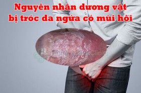 Dương vật bị tróc da ngứa có mùi hôi nguyên nhân cách điều trị