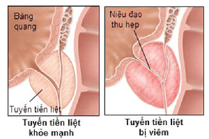 Viêm tuyến tiền liệt là gì? Nguyên nhân triệu chứng cách chữa hiệu quả nhất